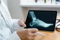 The Bone Condition That Surprisingly Increases Your Risk of Mortality