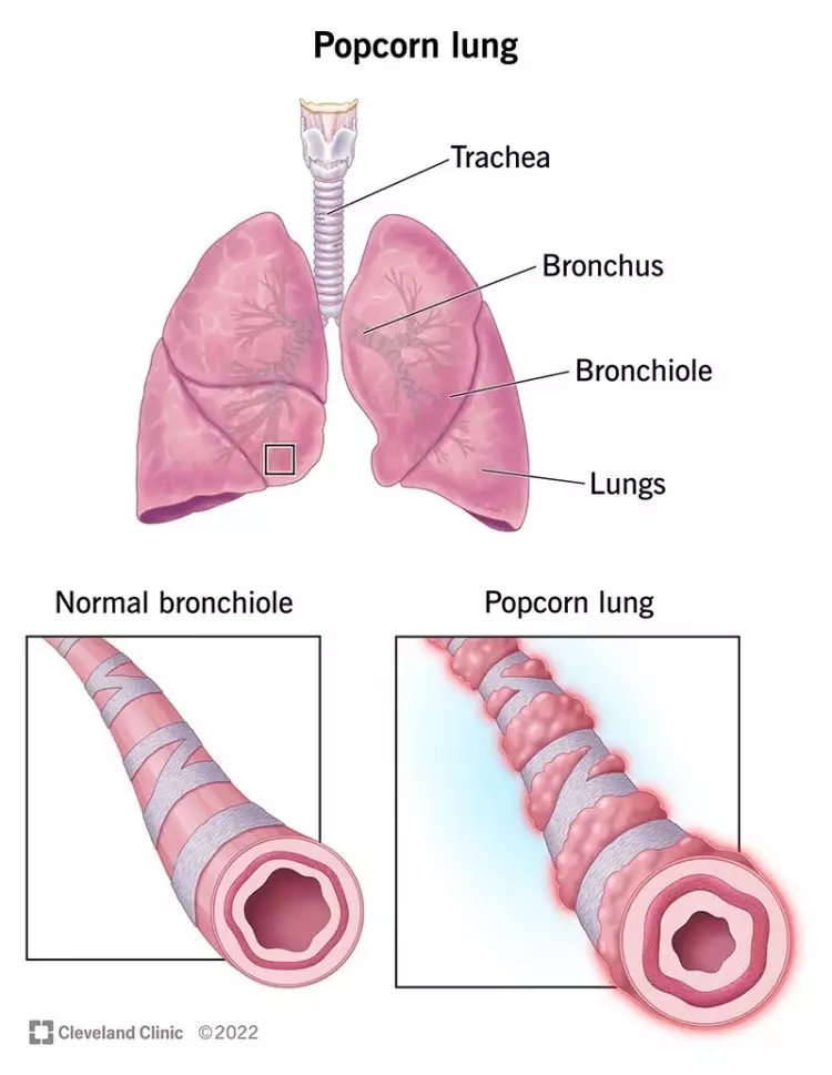 Photo Credit: popcorn lung, from Cleveland Clinic