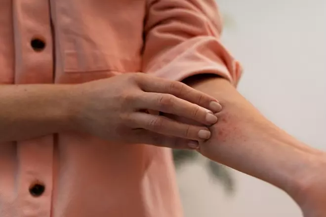 Is It Ringworm or Eczema? How Doctors Spot the Difference Photo Credit: by freepik, magnific.com
